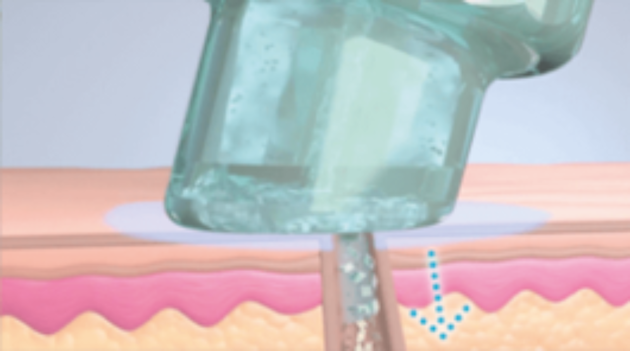 2. Schritt - GlySal™- Säurepeeling